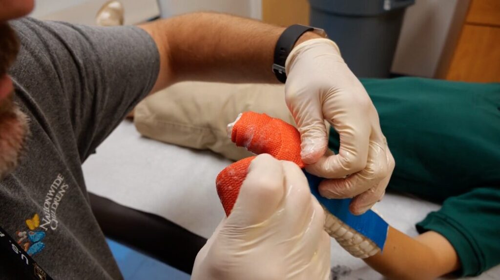 A person wearing gloves is wrapping the arm of a patient with an orange cast.